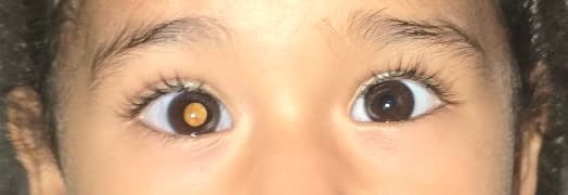 Leucocoria (reflejo blanco en la pupila): puede deberse a retinoblastoma, entre otras causas.