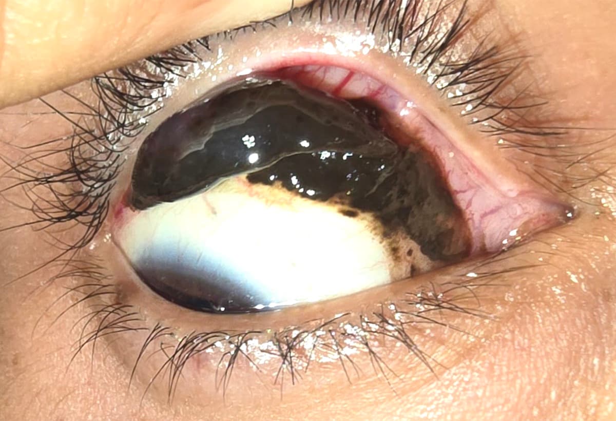 Lesión pigmentada extensa de conjuntiva