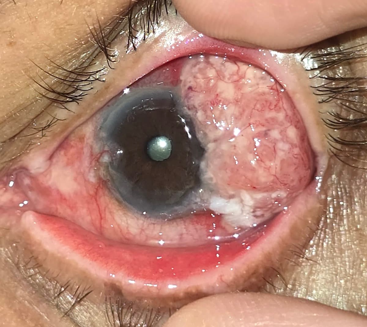 Tumor de superficie ocular en etapa avanzada
